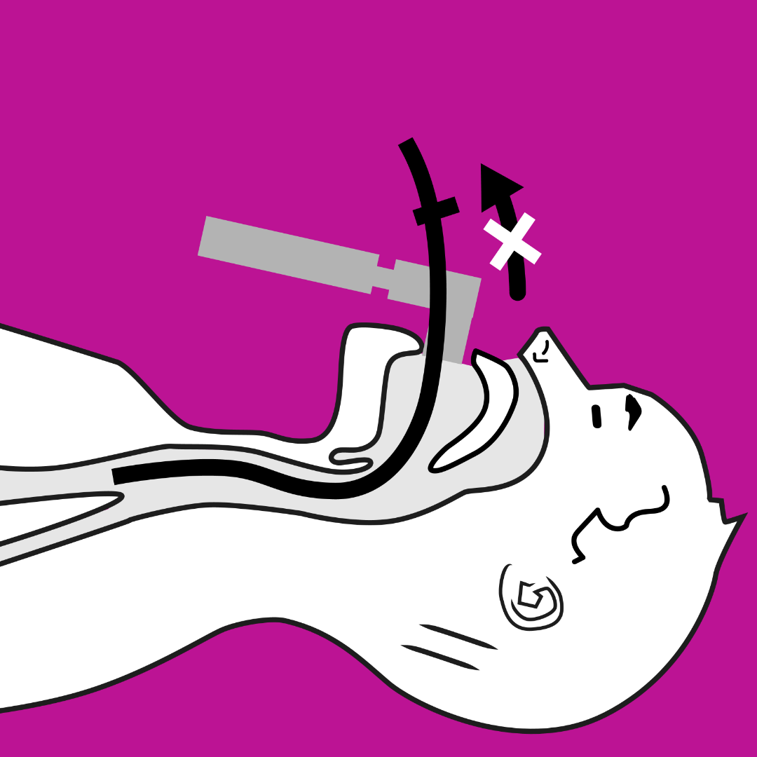 \"Intubate\"